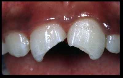 Fractured Upper Incisors