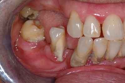 Periodontitis: Severe gum problems causing drifting of teeth and tooth loss