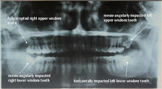 Impacted Wisdom Teeth